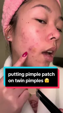why do my pimples lowkey look like a snakebite #acne #pimplepatch #acneproneskin #skincare 