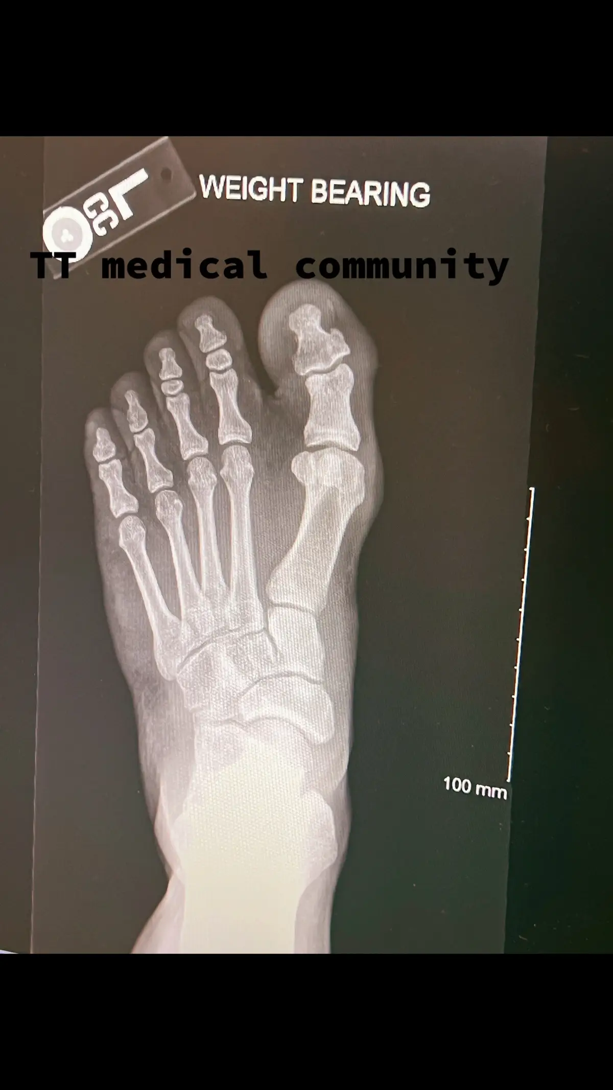 Xray of matts foot. Doctor says space between big toe and others has way to much space . Bunion is causing this, conservative treatment vs surgery? #medicaltiktok #podiatry #surgery #conserative #downsyndrome #fyp #doctor 