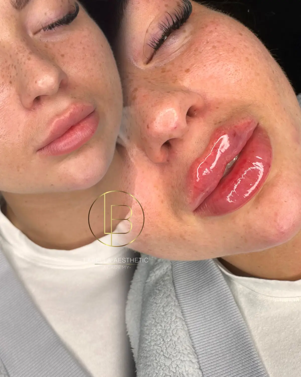 #coventryaesthetic #russianlipscoventry #russianlipstechnique #russianlipstraining #russianlipscourses #russianlipsuk #lipsbeforeandafter #buzeacidhialuronic💋 #acidohialuronico #buze #acid #dermafillers #lipsfillerlondon #lipsfillerscoventry #buzelecuroșuînchis💄 #lipsfiller #revolaxlips #stylagelips #juvaderm #powiekszanieust modelowanieust #kwashialuronowy #rozpuszczanieust #hyaluron #perfectlips    