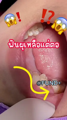🦷ไม่อยากฟันผุต้องใช้ยาสีฟันที่มีฟลูออไรด์นะ #ยาสีฟันฟันดีออร์โธพลัส #สียางฟันสุดฮิต #แนะนําสียางจัดฟัน 