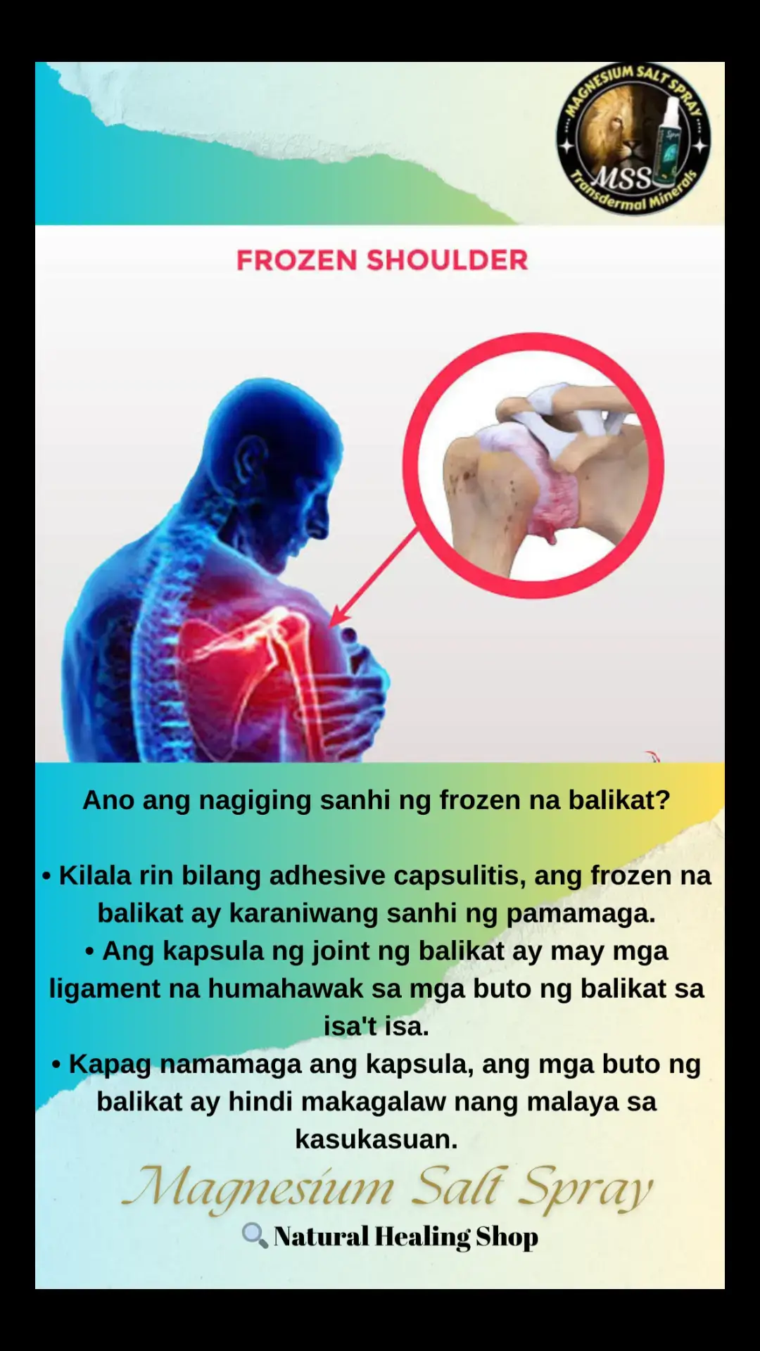 Ano ang nagiging sanhi ng frozen na balikat? •Kilala rin bilang adhesive capsulitis, ang frozen na balikat ay karaniwang sanhi ng pamamaga.  •Ang kapsula ng joint ng balikat ay may mga ligament na humahawak sa mga buto ng balikat sa isa't isa.  •Kapag namamaga ang kapsula, ang mga buto ng balikat ay hindi makagalaw nang malaya sa kasukasuan. #NATURALnaPANLUNAS #MAGNESIUMsaltSPRAY #sprayatpahidlanggagalingkana  #transdermalmineralsupplement #allinone #MSS #miraclespray #health #frozenshoulder 