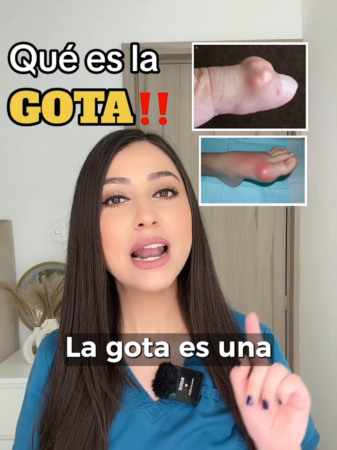 ¿Sabes qué es la gota?👩🏻‍⚕️ #salud  #medicina  #gota  #ácidoúrico  #fyp