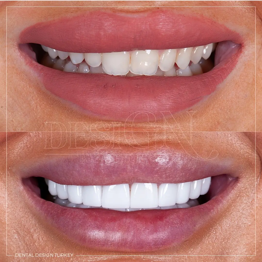 This is one of the most outstanding smiles ! She has Crystallite Laminate Veneers Colour: EXTRA WHITE (Whitest) Form : STRAIGHT (Ther is no in and outs, not roundy and more square looking) #dentaldesignturkey #dentaldesign 