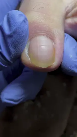 #nails #toenail #toenailremoval #ingrowntoenail #satisfyingvideo #foryourpage 