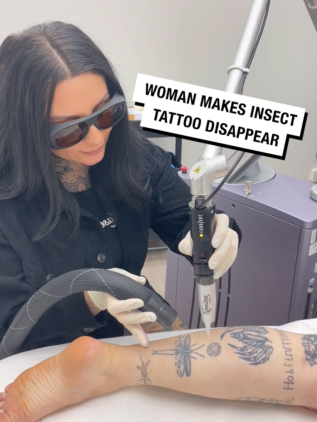 So satisfying to watch but so painful to endure! 🤣  🎥 BVIRAL / lasertat #UNILAD #fyp #foryou #foryoupage #lasertattooremoval #asmr #asmrsounds #satisfying #satisfyingvideo #tattooartist #tattoos #tattoo