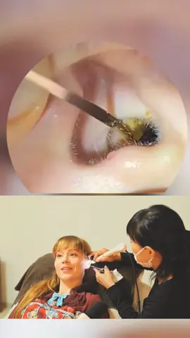 excessive earwax from the ear of an unhygienic woman #asmr  #earwaxcleaning #limpezadeouvido  #earwax #ear 