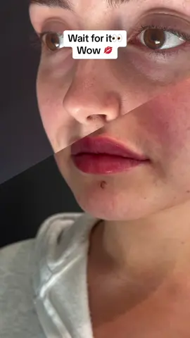 Wait for it 👀  Come with me and watch as I make this beautiful girl even more beautiful. Her request was to have defined luscious lips and to soften her nasal folds with shadow correction🙌💫🦋💋 @SkinSpirit・Med Spa BEVERLY HILLS  @galderma Model  @Julia Raleigh #pawnta 
