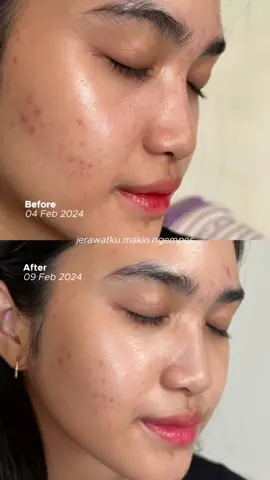 Seneng banget bisa cocok sama serum ini! + ada progresnyaaa🥹 @ERHA Truwhite Official Store #multiglowing #erhatruwhite 