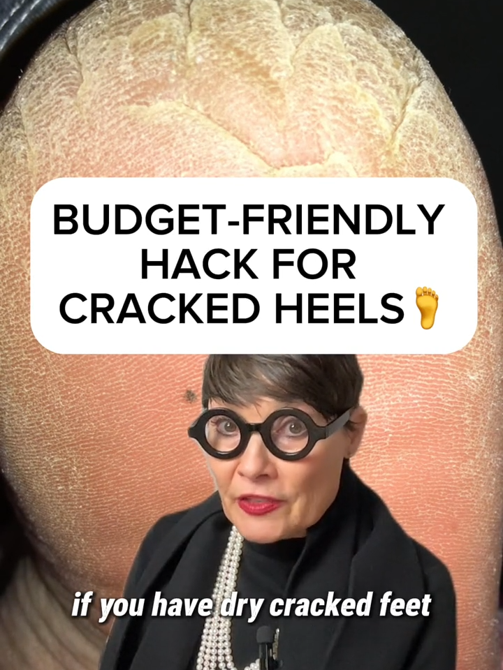 Here's my budget-friendly hack for cracked heels #crackedheels #dryfeet #budgetfriendly