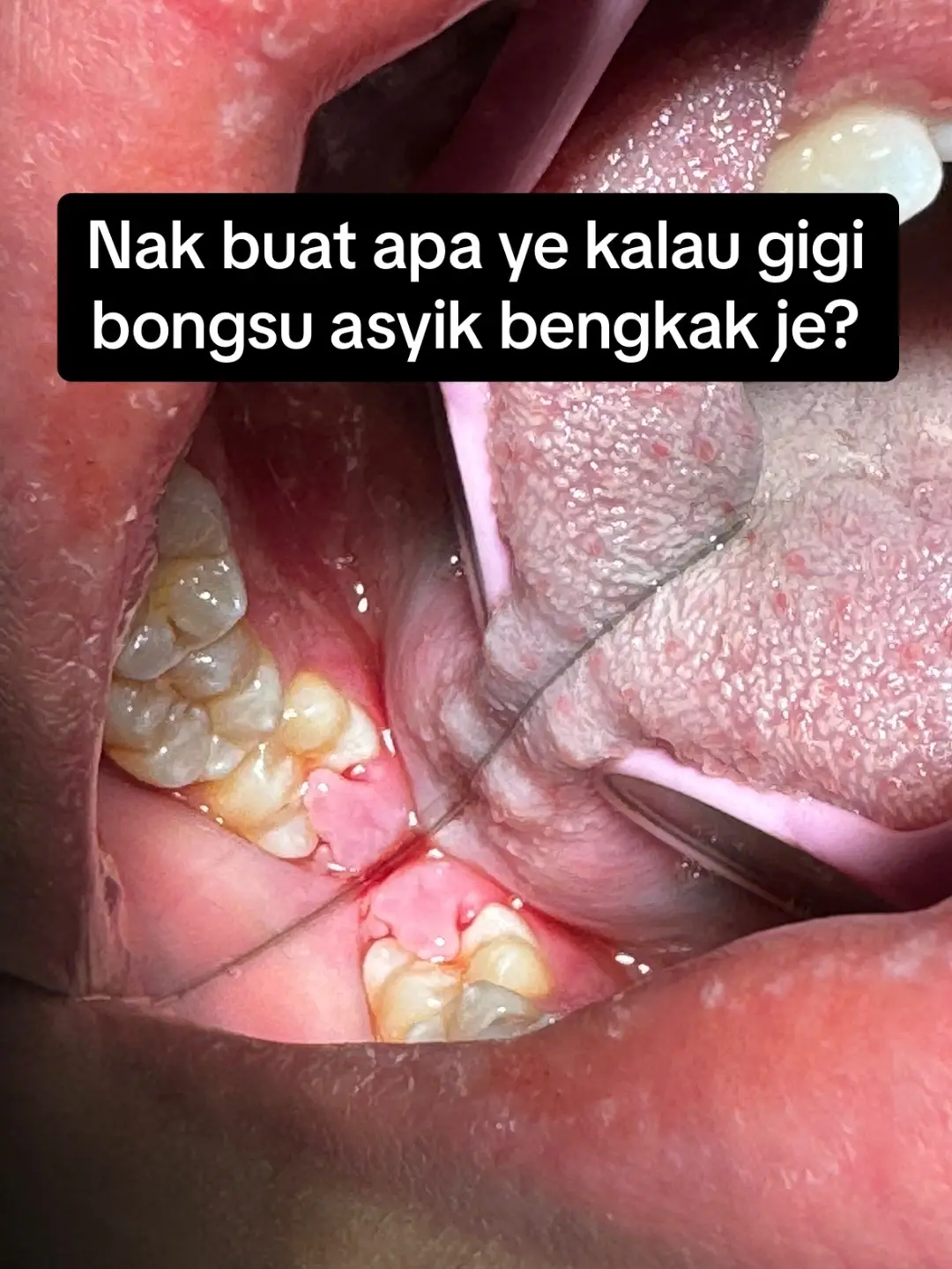 #doktorgigi #doktorgigimalaysia #doktorgigijohor #doktorgigipasirgudang #dentistpasirgudang #dentist #klinikgigi #klinikgigipasirgudang #dentalclinic #dentalclinicpasirgudang #pasirgudangproblem #drqdentistpasirgudang #jbstyle #jbstyle🔥 #jbstylebrader #operculectomy 