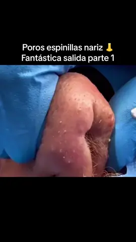 #extractions#puntosnegros#acne #grasa#espinillas #granos #poros #facial #relajante 