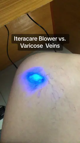If you have varicose veins, you must use Prife Iteracare Blower… and see the result. #itercaretherapydevice 