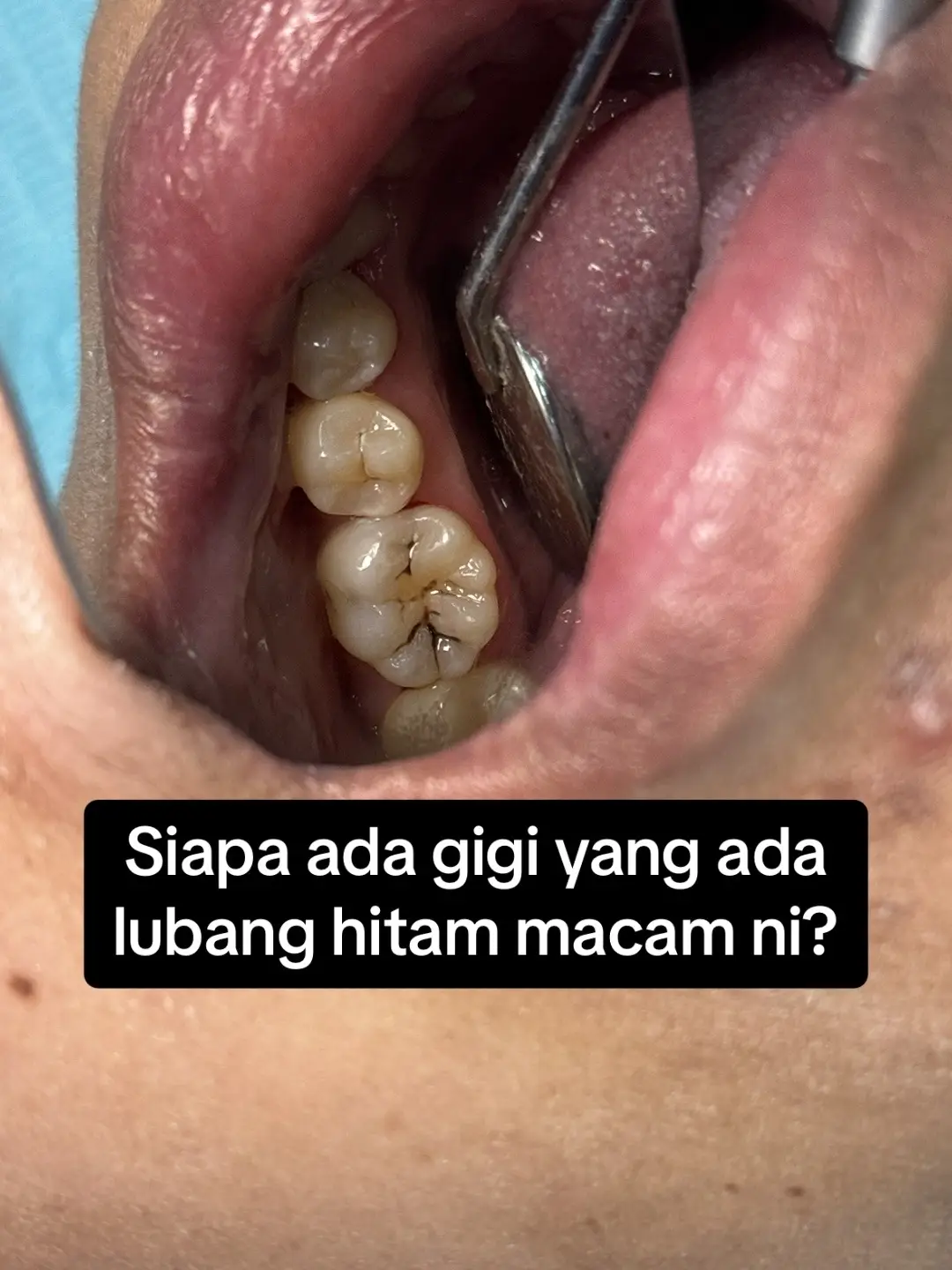 #doktorgigi #doktorgigimalaysia #doktorgigijohor #doktorgigipasirgudang #dentistpasirgudang #dentist #klinikgigi #klinikgigipasirgudang #dentalclinic #dentalclinicpasirgudang #lubanggigi #tampalgigipasirgudang 