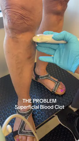 When the ONE WAY VALVES in the superficial leg veins fail pressure builds up and can cause Varicose Veins which are  set up for superficial blood clots (STP).    #STP #superficialthrombophlebitis #bloodclots #evlt #sclerotherapy #venaseal #varithena #drBonavita #drStoffey #drBonavita #drSos #venousstasis #nursepractitioner #physianassistant #polidocanol #hypertonicsaline #tetradecylsulfate 