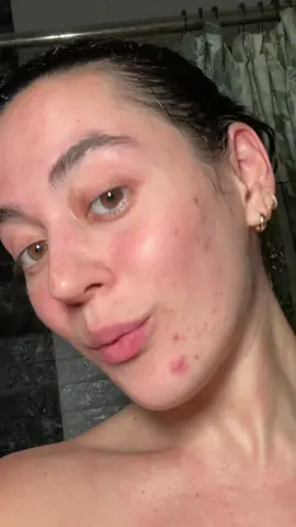 🫶🏼 #acne #hormonalacne #cycsticacne #acnejourney 