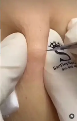#blackhead #blackheads #blackheadextraction #blackheadremovals #head #cleaning #beautyroutine  #satisfying #removal  #visage #routine  #soin #soinvisage #soins #satisfyingvideo #satisfaction #pimple #pimpleremove #acne #acneskin 