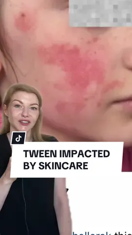The Mum was assured by the staff in stores that these products would be safe for her daughter.   I have rated Glow recipe Dew Drops for this age group as long as its patch tested. I rate Sephora. I would definitely shop at Ulta if we had in it Australia.  Responsible social media advice is where it begins. Secondly it comes down to the brands ensuring employees of the stores are educated.  Tween skincare gone wrong. Adverse reaction to tween skincare and how it happens and ways to manage it.  #glowrecipe #drunkelephant #ulta #sephora #tweenskintips #impairedbarrier #newskincare #bestskincare #dermatology 