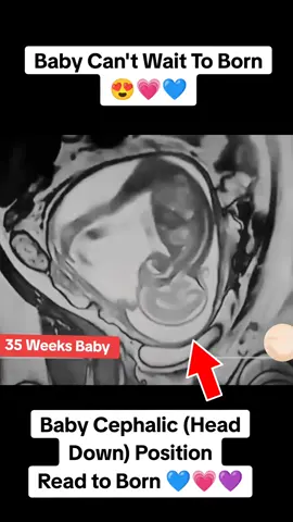 Baby in cephalic position ready to born #babyreadytoborn #deliverydate  #cephalicpresentation #37weeks #37weekspregnant #draneelamanzoor #pregnancymri #viralvideo #foryou #draneela #foryourpage #foryou #ultrasoundscan #pregnancyultrasound 