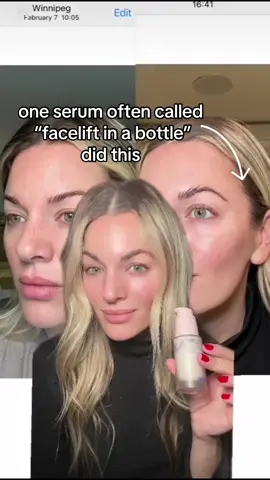 2 weeks using “facelift in a bottle” @Caudalie’s Resveratrol Serum. @sephora #antiaging #caudalie #retinolalternative #tightening #cleanbeauty #caudaliepartner #beforeandafter 