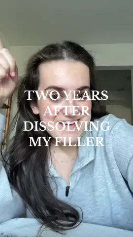 also started tretinoin, and got my pcos under control/lost 40 lbs 🫶🏻 so much happier!!! #teartroughfiller #undereyefiller #undereyefillerdissolving #fillerdissolving #dissolvingfiller #pcosweightloss #metforminpcos 