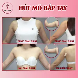 Hút mỡ bắp tay: Phương pháp loại bỏ mỡ an toàn, hiệu quả lâu dài.  Cánh tay chảy xệ, to, thô làm cho các chị em phụ nữ cảm thấy mất tự tin. Hút mỡ bắp tay bắp tay trở nên thon gọn, săn chắc nhanh chóng. --- ✧ Phòng Khám PTTM Lê Hành ✧  ・Địa chỉ: 83 Trần Thiện Chánh, P12, Q10, TP.HCM. ・Hotline: 0987 62 74 74 ・Website: https://drlehanh.vn/ #drlehanh #phongkhampttmlehanh #bacsilehanh #phongkhamlehanh #hutmobaptay 