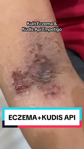 Kulit Eczema Gatal Garu Dijangkiti Kuman Jadi Kudis Api Empetigo ✌🏼️ #DrManTtdi #Empetigo #KudisApi #Eczema 