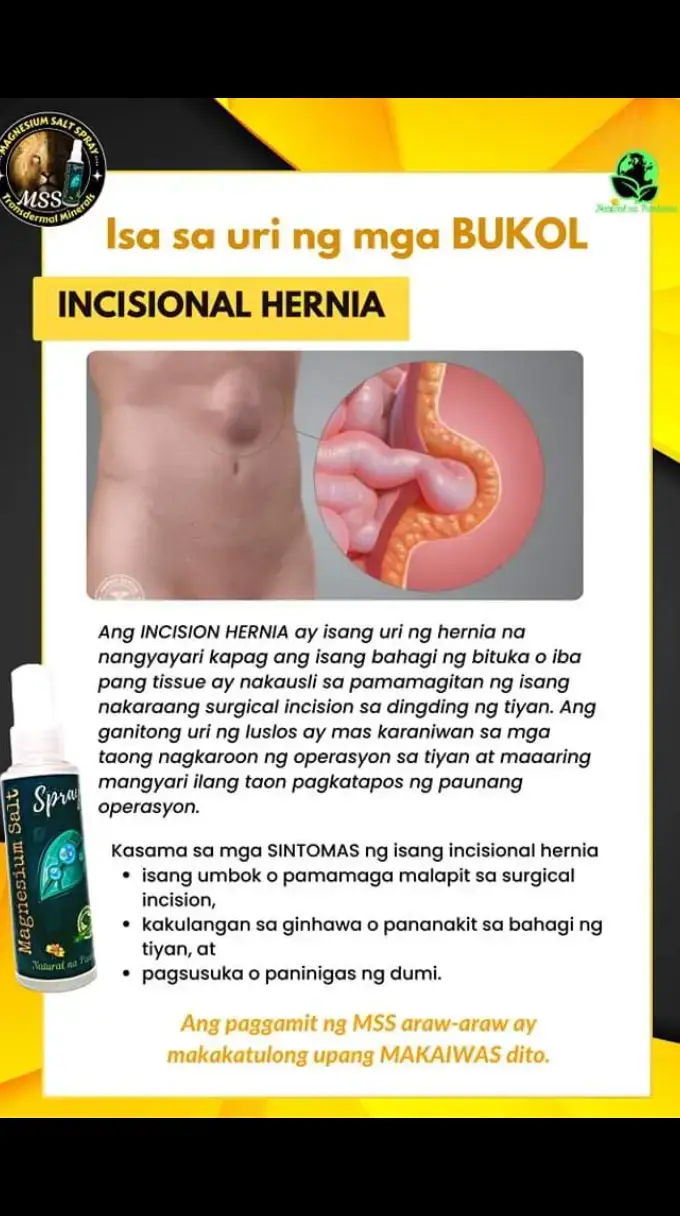 Isa sa uri ng mga BUKOL INCISIONAL HERNIA Ang INCISION HERNIA ay isang uri ng hernia na nangyayari kapag ang isang bahagi ng bituka o iba pang tissue ay nakausli sa pamamagitan ng isang nakaraang surgical incision sa dingding ng tiyan. Ang ganitong uri ng luslos ay mas karaniwan sa mga taong nagkaroon ng operasyon sa tiyan at maaaring mangyari ilang taon pagkatapos ng paunang operasyon. Kasama sa mga SINTOMAS ng isang incisional hernia -isang umbok o pamamaga malapit sa surgical incision, -kakulangan sa ginhawa o pananakit sa bahagi ng tiyan, at -pagsusuka o paninigas ng dumi. Ang paggamit ng MSS araw-araw ay makakatulong upang MAKAIWAS dito. #MSS #MAGNESIUMsaltSPRAY #NATURALnaPANLUNAS #magnesiumdeficiency #magnesiumbenefits #naturalnapanlunasadvocate #minerals #allinone  #transdermalmineralsupplement #amazing #health #hernia 