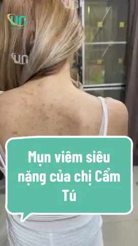 Uni - địa điểm điều trị viêm mụn hàng đầu Việt Nam. UNI cam kết điều trị mụn viêm, thâm mụn không hiệu quả Hoàn Tiền. #phongkhamquocteuni #xh #tiktok #viemnanglong #mụn_viêm #mụnlưng #lamdep #mụn 