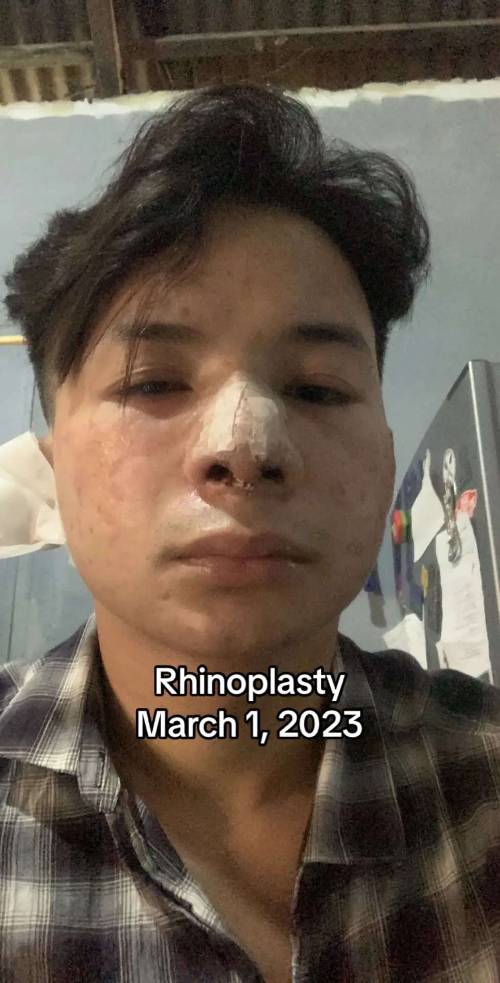 #fyp #viral #trending #foryoupage #tiktok  #rhinoplasty  #nosejob  #GlowUp 