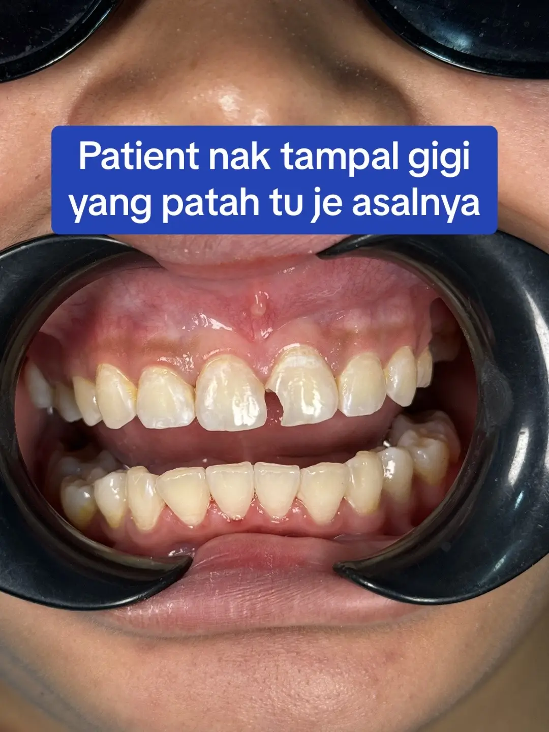 #doktorgigi #doktorgigimalaysia #doktorgigijohor #doktorgigipasirgudang #dentistpasirgudang #dentist #klinikgigi #klinikgigipasirgudang #dentalclinic #dentalclinicpasirgudang #pasirgudangproblem #drqdentistpasirgudang #jbstyle🔥 #jbstylebrader #jbstyle 