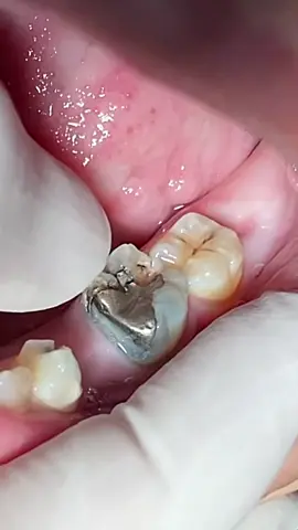 Crown is very important to protect root canal treated tooth #dentist #tooth #teeth #viral 