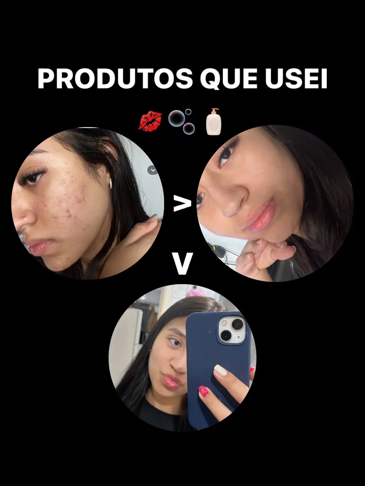 os melhores produtos para acabar com essa pele tenebrosa…#acne #foryou #viral #daily 