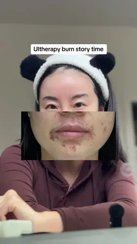 This was not how i wanted my 2024 to start… if you are going to ever need numbing cream just know it can burn your face if left too long 🥲 #ultherapy #medspa #30plus 
