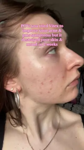 Wanted to make my skin better, but made it worse 🥲 Or my story with Vitex - a herb to balance pms symptoms.  Vitex (Agnus Cactus, chasteberry) is a herb that is usually prescribed as a supplement to improve pms symptoms during the luteal phase. It increases progesterone & decreases estrogen.  My female doctor recommended me this supplement to take for 3 month, only 4 mg per day. I decided that it would be perfect for me as I had low progesterone in the past & my acne was blooming before my period.  But I was able to take it only for 2 weeks because I stated to deal with side effects:  Extreme acne worsening 😥 now it looks like it was before accutane.  Bloating.  Mood swings.  + the only positive effect - bigger breasts 😅 but it’s not so important compared to the issues I have gotten.  I’m not taking it anymore obviously, since today. I don’t know how long it will take for me to recover my skin. But I’m proud of myself that I stopped taking it early, without waiting for a miracle.  Important: that’s only my story, not a medical advise! Vitex helps many women worldwide but sadly it wasn’t my case. And never take this herb with no consultation. 