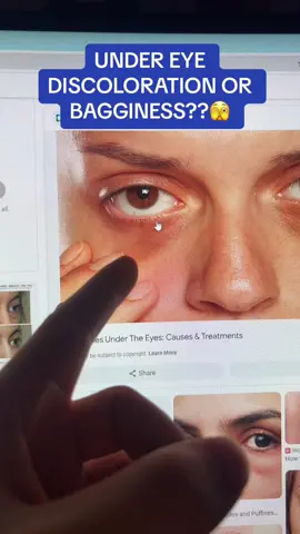 I got you guys #foryou#bagsundermyeyes#sleepy#tired#facecare#facialtreatments#undereyebags#undereyecircles 