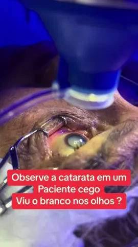 Cirurgia de catarata em paciente “cego”. Observe o branco dos olhos, esse é o cristalino no ultimo estagio da doença. #cirurgiadecatarata #oftalmologia #ophthalmology #medicina #cegueira #visao #saude