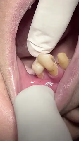 Extraction of upper first premolar tooth with mobility #dentist #extraction #tooth #teeth #dentista 