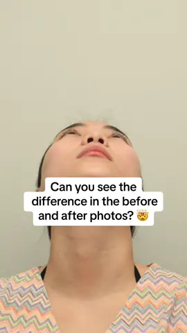 Can you see the difference? #rhinoplastybeforeandafter 