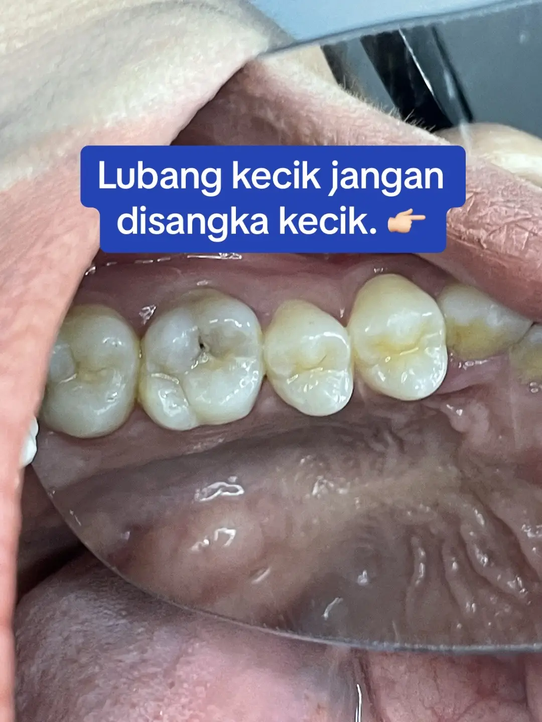 #doktorgigi #doktorgigimalaysia #doktorgigijohor #doktorgigipasirgudang #dentistpasirgudang #dentist #klinikgigi #klinikgigipasirgudang #dentalclinic #dentalclinicpasirgudang #sapphiredental #klinikpergigiansapphire #pasirgudangproblem #drqdentistpasirgudang #jbstyle🔥 #jbstylebrader #jbstyle #tampalgigipasirgudang 