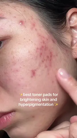 i use these toner pads and the serum and they have really been helping with my hyperpigmentation this is definitely on my repurchase list #glutathione #PHA #LHA #gentleexfoliation #exfoliation #brightening #whitening #hyperpigmentation #darkspot #tonerpad #kbeauty #koreanskincare #numbuzin  #numbuzintonerpad #numbuzinpad #no5tonerpad #no5pad  