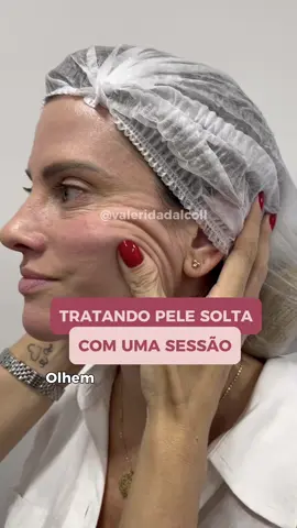 Resultado incrivel com apenas uma sessão! #hof #botox #preenchimento #harmonizacaofacial #botoxnatural 