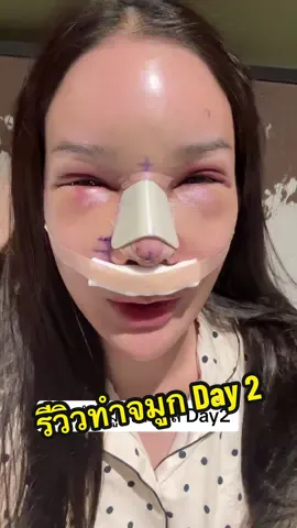 วันนี้หน้าจ๋าเหมือนอะไรคะทุกคนนนนน 5555🤣 #จ๋าเจ้าของแบรนด์อีฟส์ #เจ้าของแบรนด์อีฟส์ #EVES #แซนตามใจเมีย #แม่จ๋าพ่อแซน #กินไปกับจ๋า #ไอดอลเลยแม่ #ศัลยกรรม #รีวิวจมูกหลังทําเสร็จ 