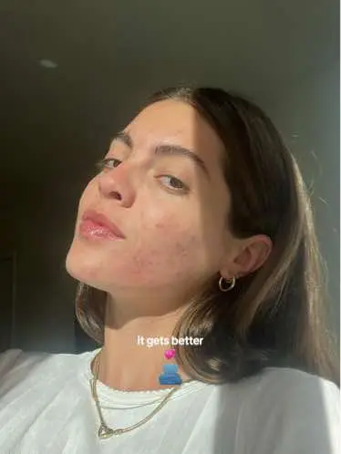Its crazy to think i would convince myself that it wasnt even “that bad” 😣😣😣  We are healing… 🫧💫💌💞#acne #acnejourney #acnefighter #accutane #accutanejourney #accutanecheck #acneskin #progress #hanginthere #mindsetmotivation #staystrong #acneprome #acnecommunity #fungalacne #cysticacne