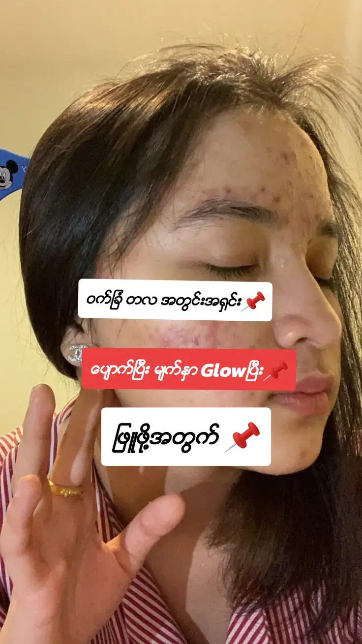 #ဝက္ျခံတလအတြင္းအ႐ွင္းေပ်ာက္ဖို႔ #ဝက္ျခံေပ်ာက္ခ်င္သူမ်ားအတြက္ #skincarebeauty #beautycare #skincareknowledge #nwaynwaybyskincare #thank4youdo #foryou 