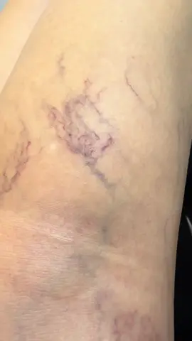 Escleroterapia vara varices. Mty. NL.#varicesyarañitas #varicesenlaspiernas #escleroterapiaconespuma #varices #varicesgrandes 