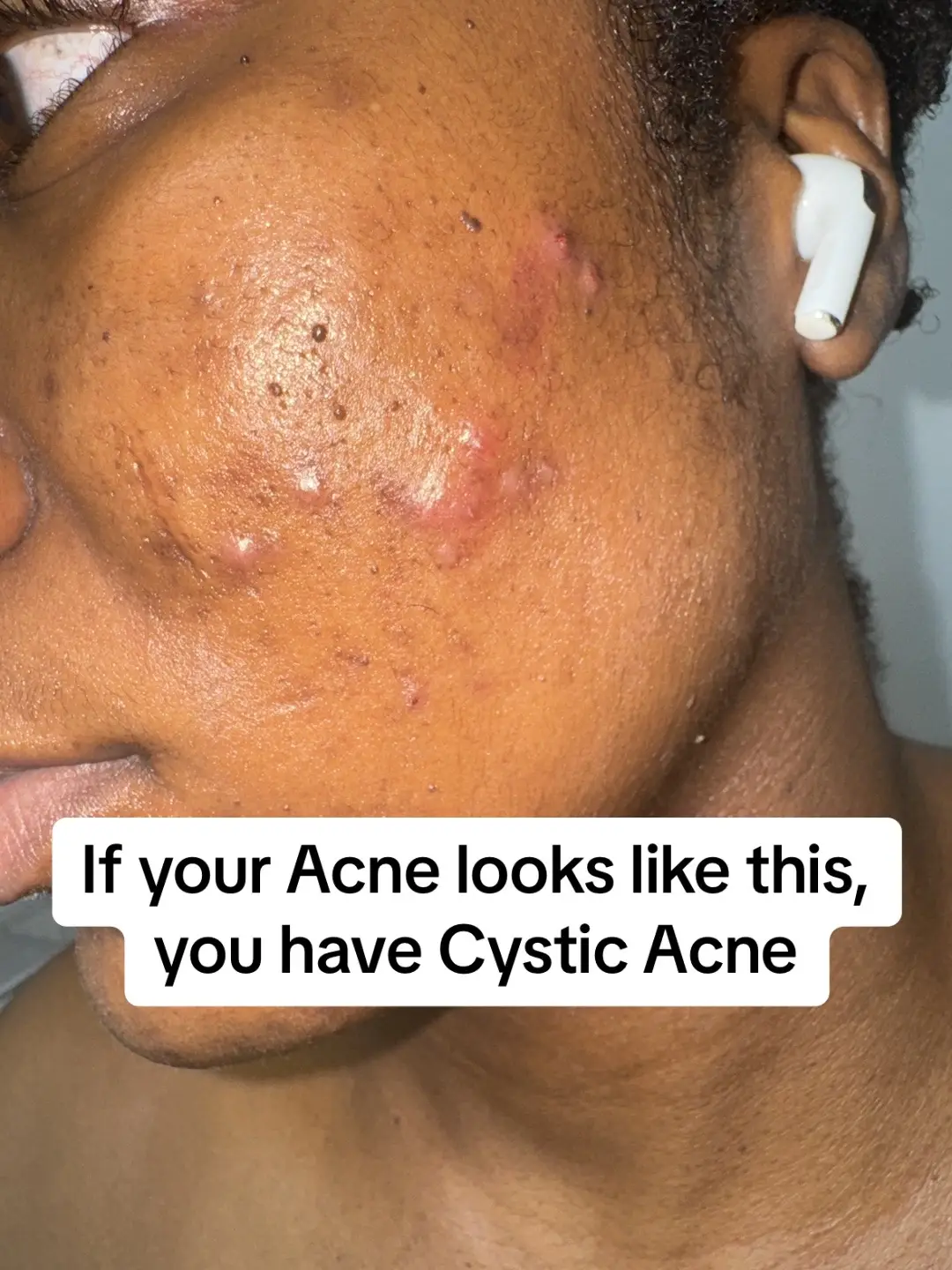 #cysticacne #adapalene #morningskincareroutinetretinoin #nightskincareroutine #adapalenenightskincareroutine #tretinoin #cysticacnescare #acnesolutions #hyperpigmentationsolution #benzoylperoxide #barrierrepair #skinbarrierrepair #panoxylfacewash 