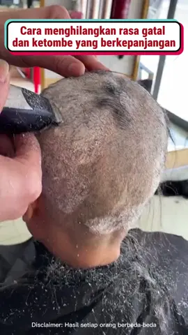 Solusi mengatasi jamur dan ketombe di kulit kepala #kirozi #shampokirozi #ketombe
