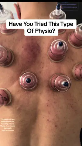 Feeling like your back's a knot? Cupping physio can help! Watch these cups work their magic, loosening tension & leaving you feeling ahh-mazing #cuppingtherapy #backpainrelief #fyp #wellnesshacks #hertscupping #cupping #cuppingmassage #physiotherapy #cuppingphysio #physiocure #physio  Cupping therapy Physiotherapy Tension Release