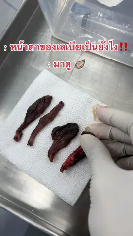 ปิดตำนานปีกผีเสื้อ🦪❌#qclinic #คิวคลินิก #รีวิวเลเบีย #เลเบีย #ศัลยกรรมตกแต่งน้องสาว #ปัญหาน้องสาว #ศัลยกรรมน้องสาว #รู้จากtiktok #เลเบียคิวคลินิก #หมอโบนัสคิวคลินิก #หมอชายคิวคลินิก #รีแพร์คิวคลินิก #ศัลยกรรมน้องสาวคิวคลินิก 