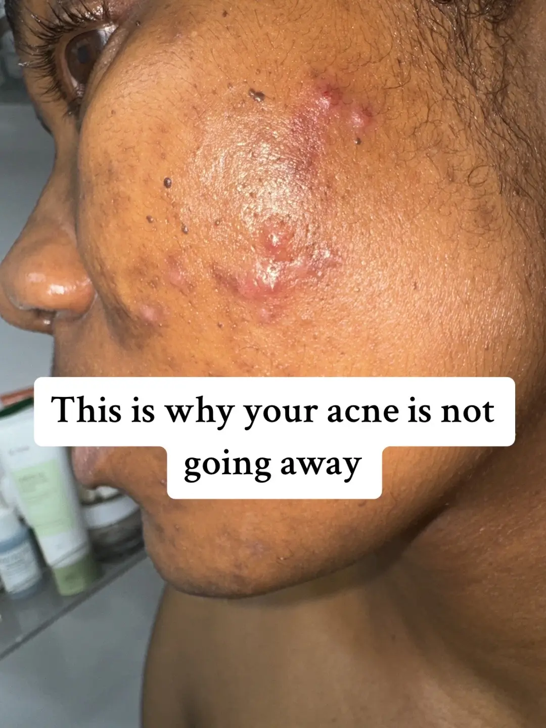 Your acne solution products takes 4-8weeks before you can see visible results 🥳 And try no to over exfoliate or use too many actives on same routine, your acne will only get worse if you do that  #solutionsforacne #whyismyacneproductsnotworking #cysticacne #homonalacnesolution #homonalacne #salicylicacidcleanser #salicylicacid #exfiolation 